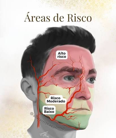 Ilustração das zonas de risco vascular da face usada em curso de anatomia para injetáveis